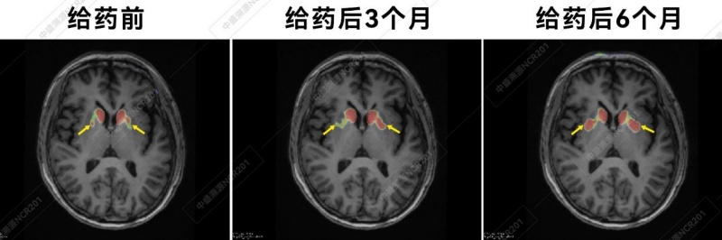 帕金森病治疗启新程！NCR201注射液Ⅱ期临床启动会圆满落幕， 多方聚力共筑希望-图片4